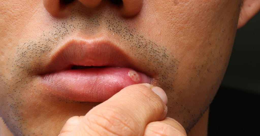 Aft Neden Olur, Nasıl Geçer ve Ne İyi Gelir? Aft Tedavisine Evde Ne İyi Gelir?