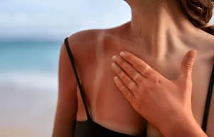 Güneş Yanığı Evde En Hızlı Nasıl Geçer? Güneş Yanığı İçin Doğal Yöntemler